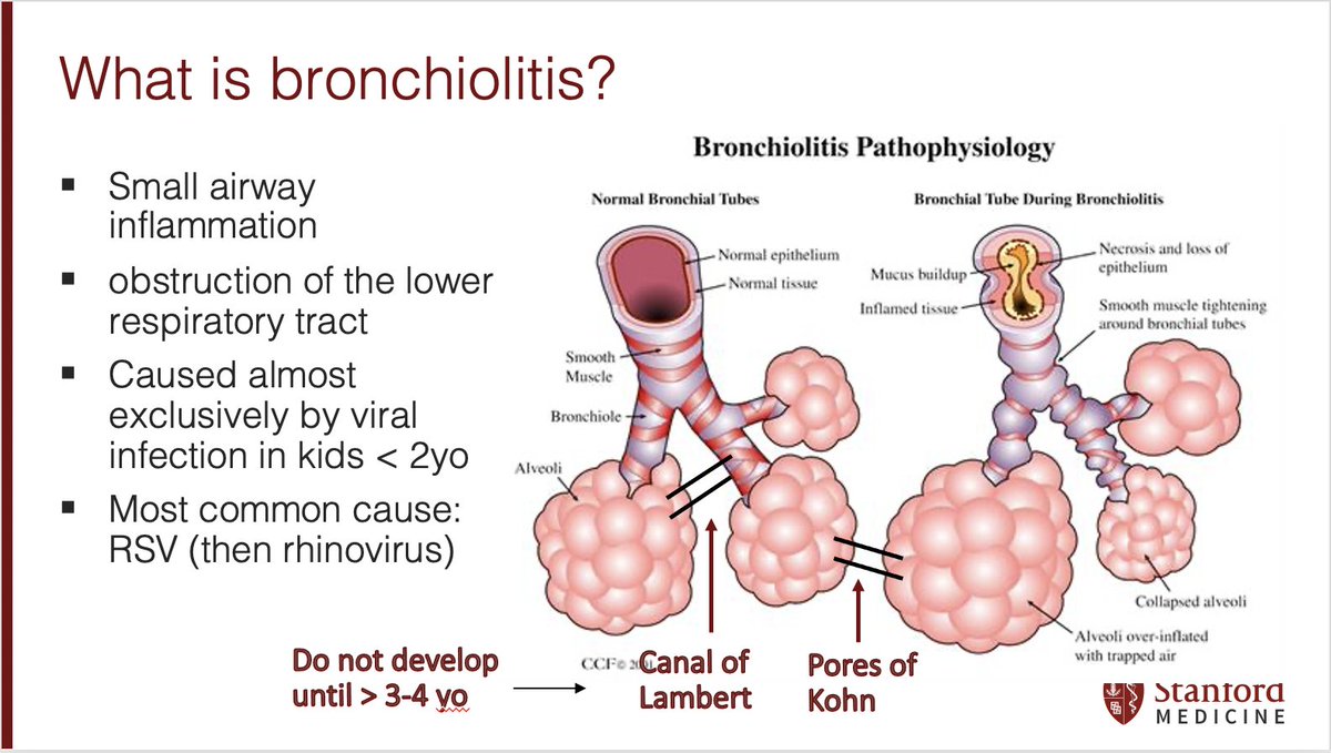 3/ Hm..the pores of what??? Babies' lungs don't have the ability to participate in collateral ventilation so V/Q mismatch & inadequate ventilation of obstructed alveoli is common in young infants with bronchiolitis. Perhaps why kids <2 years fare worse than their older friends?