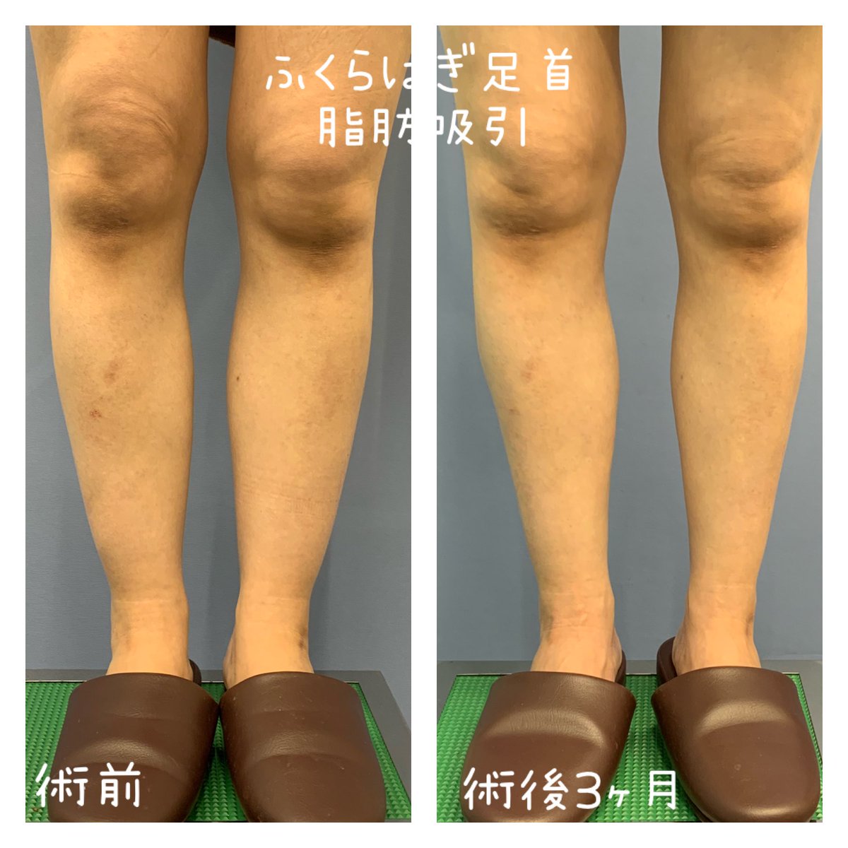 湘南美容クリニック 高松院院長 多田彩子 ふくらはぎ脂肪吸引 下半身脂肪吸引21年1月28日岡山院期日限定モニター様1名募集中です カウンセリングは高松院で事前にご予約ください 美容 部分痩せ 湘南美容クリニック 湘南美容外科 無料