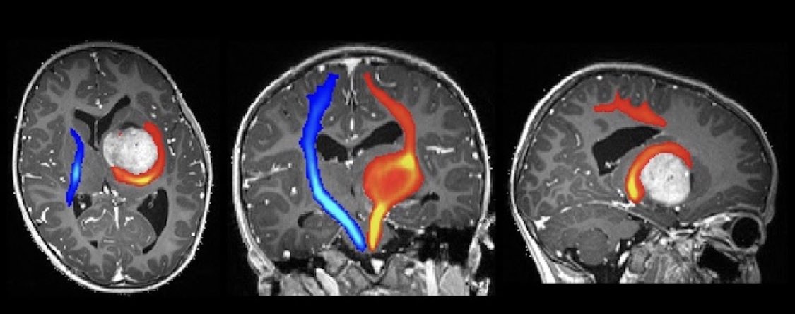 In keeping with the vast literature on this topic, most neurosurgeons used tractography as an adjunct for brain tumour resection, like in the case below (2/5)