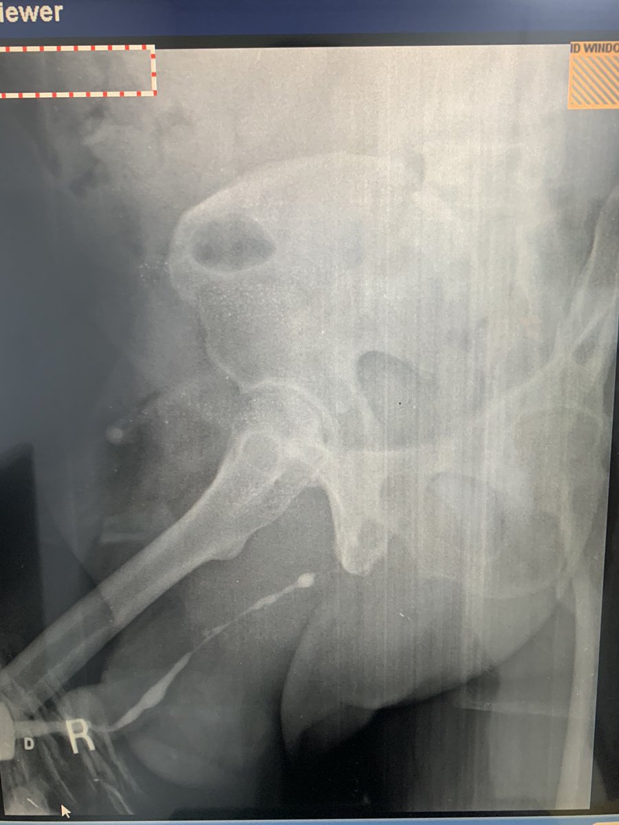 DongNguyeb's tweet photo. @trwherrmann @AeepThe I just got this case today novel stricture after Bipolep! https://t.co/HQkrJTd4OV
