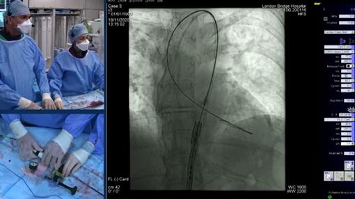 PCRonline's tweet photo. Watch this virtual LIVE case from #PCRValves with operators @drtpatterson &amp; Simon Redwood in a #TAVI in bicuspid case:

a 77-y-old low-risk female patient with symptomatic aortic stenosis and bicuspid valve suitable for TF access...

View 📺https://t.co/rQlPFAs2JB #TAVR #cardioed https://t.co/Q7bsnQnJ26