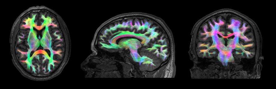 icometrix's tweet photo. Study Dr. Ping-Hong Yeh on long. changes of WM following #TBI: varying WM fractional anisotropy (FA) trajectories as potential prognostic biomarkers for post-TBI recovery/deterioration; FA =❗️metric for studying tissue integrity of TBI patients. https://t.co/7r3Q56oHfl #icobrain https://t.co/gZKgtcntK0