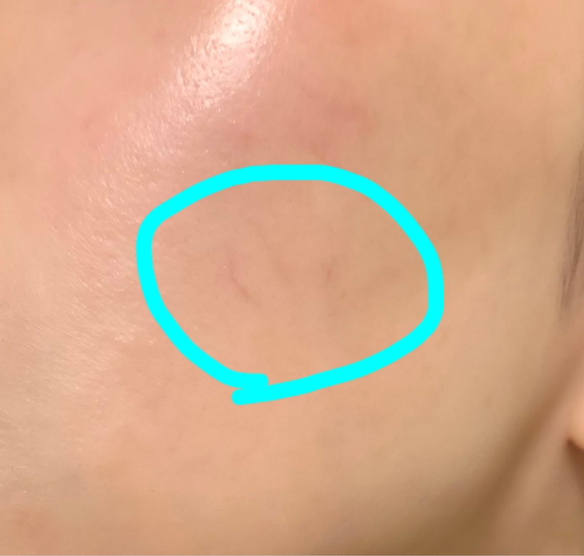 ゆずゆさん 酒さによる赤ら顔でフォトフェイシャルicon5回目終了 冷えのぼせで赤みが出ても前ほど真っ赤にはならない 1番分かりやすく毛細血管見える部分に丸した 肌の色違うので イマイチだけど やる前と今日 今年1番やってよかったこと