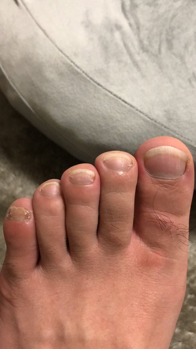 汚爪からの這い上がり育爪マン 汚いけど足 昔はこれも剥いでいました