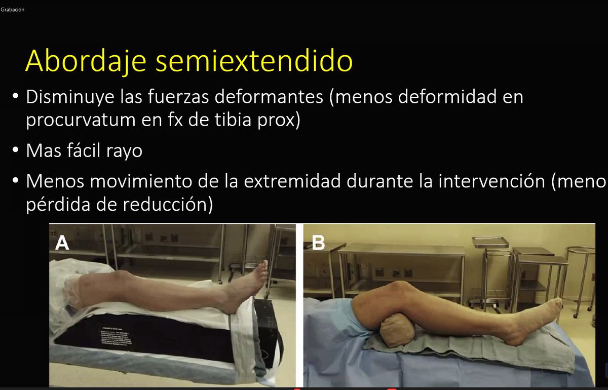 cot_csi's tweet photo. Para acabar el módulo de hoy, la Dra. Alina Ortega, desde Liverpool University Hospitals, nos responde a la pregunta "¿En el manejo de las fracturas diafisarias de tibia, pueden coexistir las placas y los clavos? Accesos quirúrgicos de los clavos" #FracturaTibia #orthotwitter https://t.co/AqxD7nx7KI