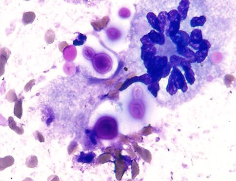 sza_jhcyto's tweet photo. An Impressive Appearance- Lung mass in a young man, “Cryptococcal Infection”. https://t.co/so6lUp40dX