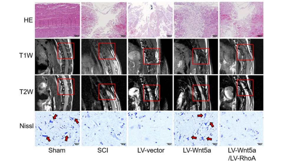 NeuralCell's tweet image. ☀️ Sun Yat-Sen University scientists found that miRNA200b-3p was critical for Wnt5a-induced #NeuralStemCell differentiation into #neurons to promote motor functional and histological recovery after spinal cord injury 🦴.

go.nature.com/3mlAeo5
