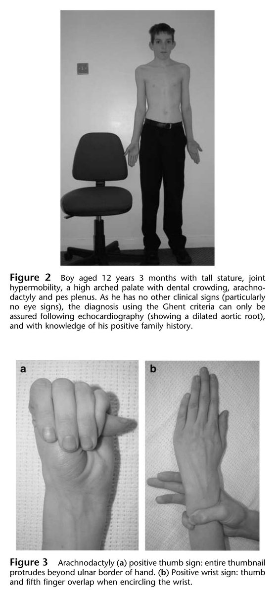 #MarfanSyndrome

Joint hypermobility

🔸 Positive thumb: entire thumb protrudes beyond the ulnar border of the hand 

 🔸 Positive wrist sign: 5th finger and thumb overlap

#JointHypermobility #Marfans