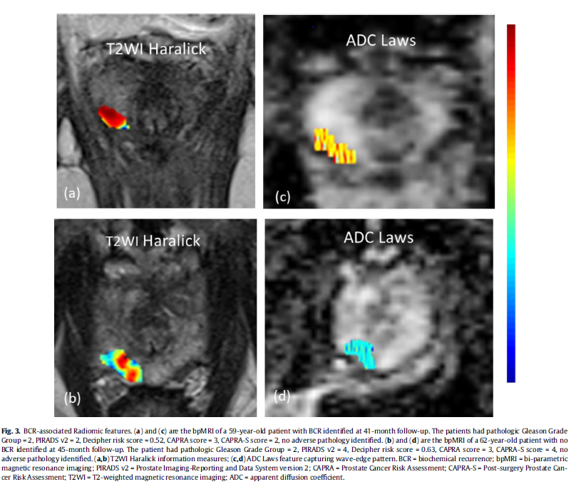 radiolobt's tweet photo. A novel imaging based Nomogram for predicting post-surgical BCR and adverse pathology of #prostatecancer from pre-operative bi-parametric MRI https://t.co/fxSDVsalhx
"All key future parts are in this paper #bpMRI #radiomics #prognosis #BCR congrats to @anantm and team" https://t.co/EANODAsWD9