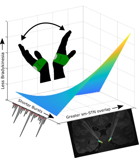 Brain1878's tweet photo. Kehnemouyi et al. show that improvement in mobility from DBS in Parkinson's disease can be predicted from the combination of specific changes in beta band activity and the precise volume of tissue modulated by neurostimulation. https://t.co/P9XPtv2v41 https://t.co/GDQdZiGIHB