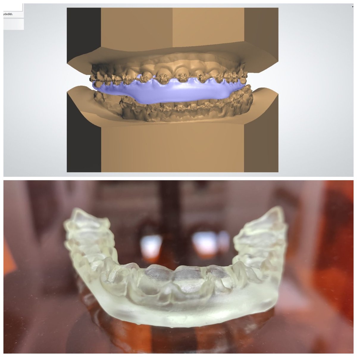 Teknolojik gelişmeleri ortodonti tedavilerine yansıtma konusunda tutkulu olan kliniklerimizden @ortodonti_klinigi Ortodontist Ufuk Demir beyle tellere dokunmadan, sınır ötesi hareketler 🤓