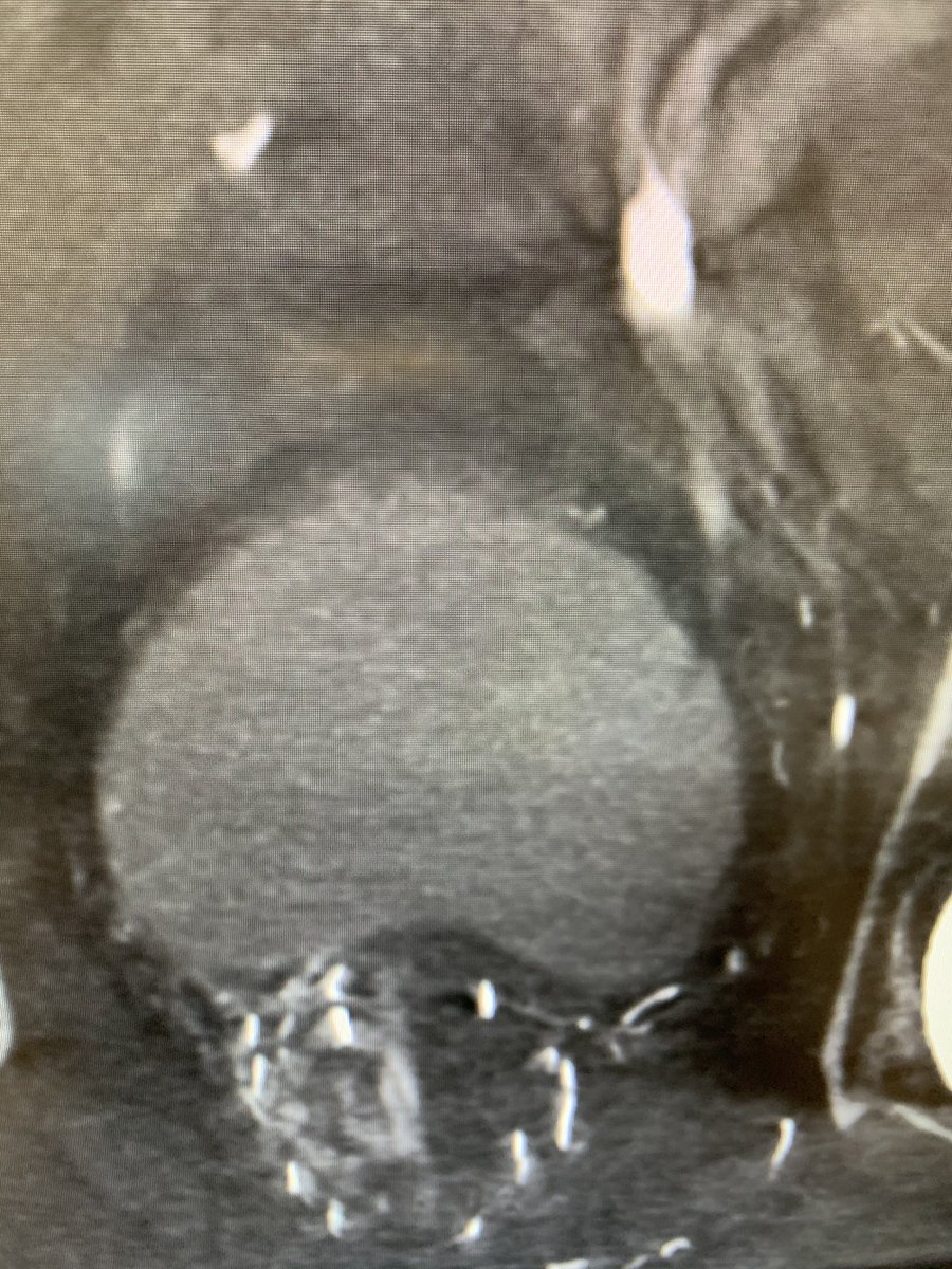 Ari Isaacson (@ariisaacsonmd) on Twitter photo Another good application of PAE: treatment of LUTS s/p XRT/Brachytherapy. <a href="/UNCurology/">Urology@UNC</a> <a href="/UNCRadOnc/">UNC Department of Radiation Oncology</a> <a href="/clarelouisebent/">Clare</a> <a href="/SandeepBaglaMD/">Sandeep Bagla MD</a> <a href="/keithppereira/">Keith Pereira MD, #VIrad</a> <a href="/bonesz/">Aaron Fischman MD | Interventional Radiologist</a> @JeremyKimMD <a href="/SamMouli/">Sam Mouli</a> Another good application of PAE: treatment of LUTS s/p XRT/Brachytherapy. <a href="/UNCurology/">Urology@UNC</a> <a href="/UNCRadOnc/">UNC Department of Radiation Oncology</a> <a href="/clarelouisebent/">Clare</a> <a href="/SandeepBaglaMD/">Sandeep Bagla MD</a> <a href="/keithppereira/">Keith Pereira MD, #VIrad</a> <a href="/bonesz/">Aaron Fischman MD | Interventional Radiologist</a> @JeremyKimMD <a href="/SamMouli/">Sam Mouli</a>
