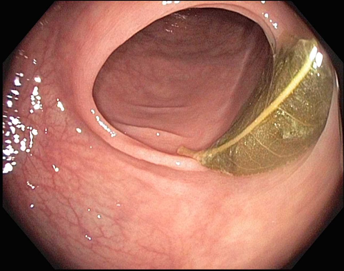 A good bowel prep will leaf no residue behind. #GITwitter #MedTwitter <a href="/somedocs/">Doctors On Social Media</a> <a href="/SoMe4endoscopy/">SoMe4endoscopy</a> <a href="/BilalMohammadMD/">Mohammad Bilal, MD</a> <a href="/DCharabaty/">Aline Charabaty, MD, FACG, AGAF</a> <a href="/mdmarathon/">Justin Kupec</a> <a href="/drkeithsiau/">Keith Siau</a> <a href="/stevenbollipo/">Steven Bollipo</a> <a href="/GI_Pearls/">GI Pearls</a> <a href="/DrHarryThomas/">Harry Thomas</a> <a href="/DrReddyGI/">Naveen Reddy</a>
