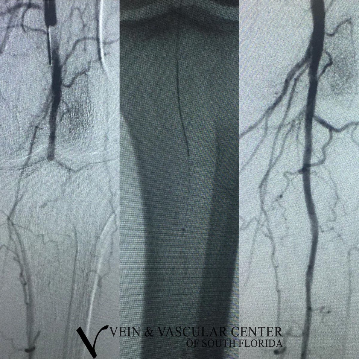 GotVeins's tweet photo. Left leg intervention for ischemia. #pvd #vascularsurgery #vasculardisease #endovascularsurgery. We used #athrectomy #stent and #angioplasty #crosser device from #bd #bard to resestablish #blood flow to save the left leg from #amputation #drfeldbaum https://t.co/42L6WJ4TzB
