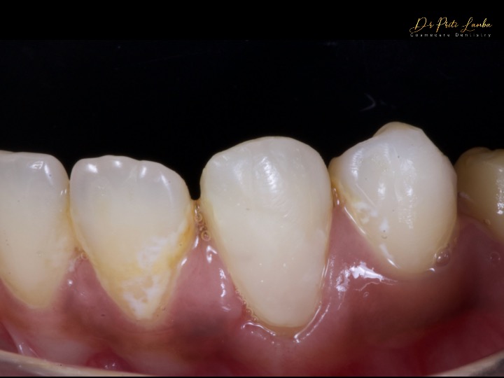 PulpdenTweets's tweet photo. #Repost ππ¦· Dr. Priti Lamba shared these clinical images with us after using #Pulpdent #ACTIVAPronto β
"Treating the class 5s can be very stressful ..not if you follow the protocol!" -@dr.pritilamba
https://t.co/zDEWyHiNAs https://t.co/2Q327jkeoe
