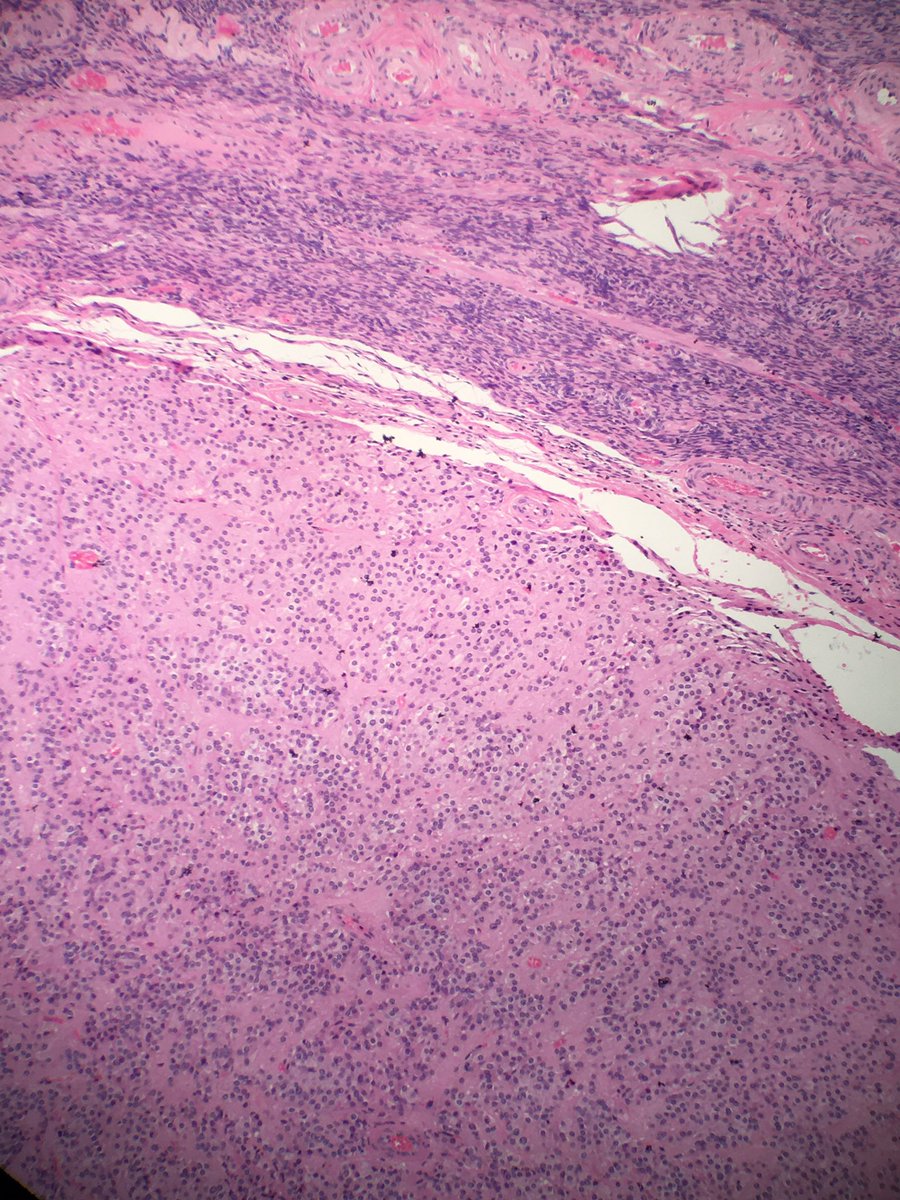 yMDPhD's tweet photo. Where are we, and what do you think it is? What stains would you order to support your diagnosis?

#PathBoards #Pathology

@natasharekhtman @AmlLabib @BinXu16 @anotherpathres @BeccaBrass @IHC_guy @ahsanuitis @tlabiano @AnnieMcLeanDMD @HNPathology @ERDENEROZER @pathophil https://t.co/6oaFcQP8Dj