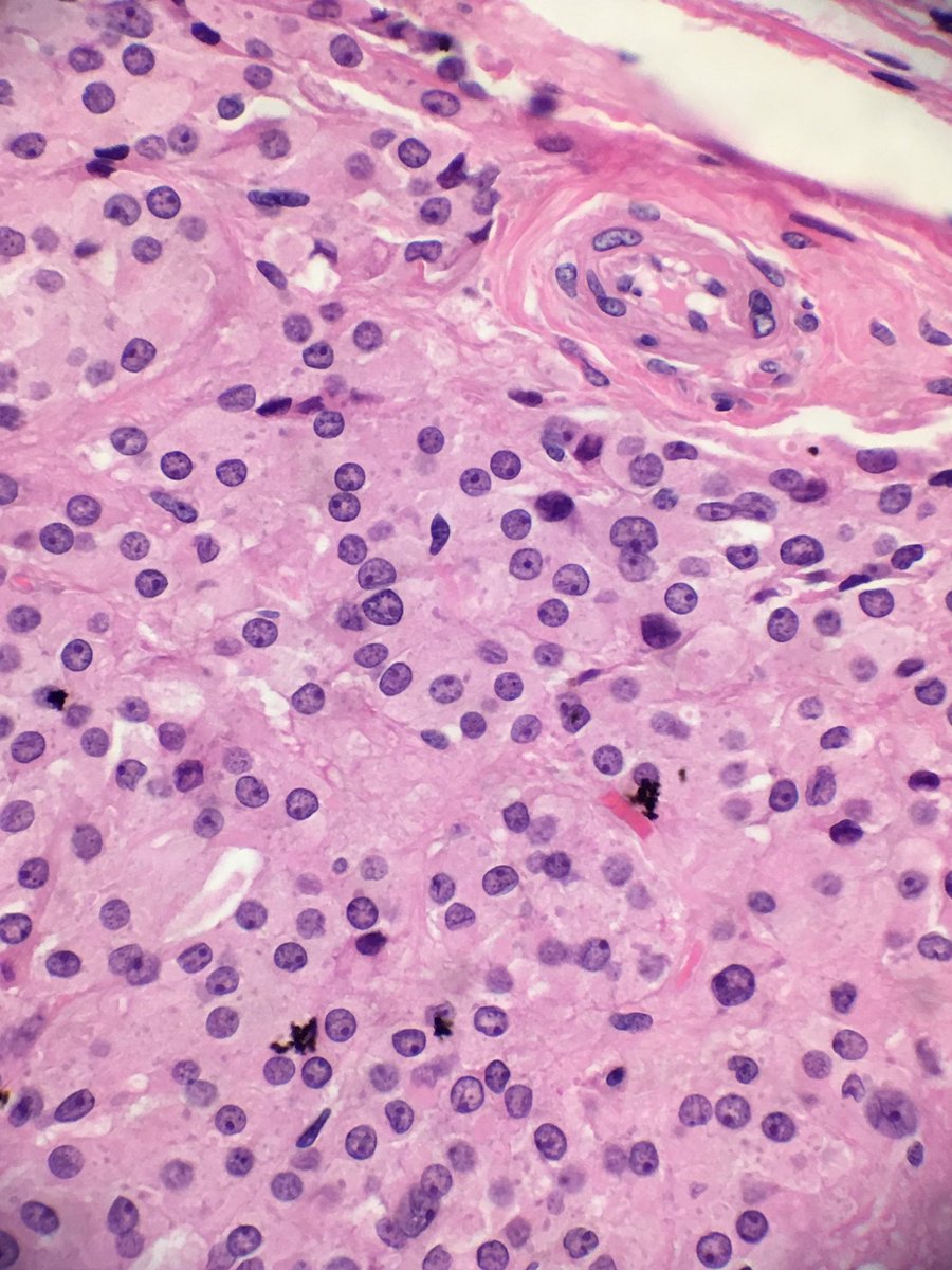 yMDPhD's tweet photo. Where are we, and what do you think it is? What stains would you order to support your diagnosis?

#PathBoards #Pathology

@natasharekhtman @AmlLabib @BinXu16 @anotherpathres @BeccaBrass @IHC_guy @ahsanuitis @tlabiano @AnnieMcLeanDMD @HNPathology @ERDENEROZER @pathophil https://t.co/6oaFcQP8Dj