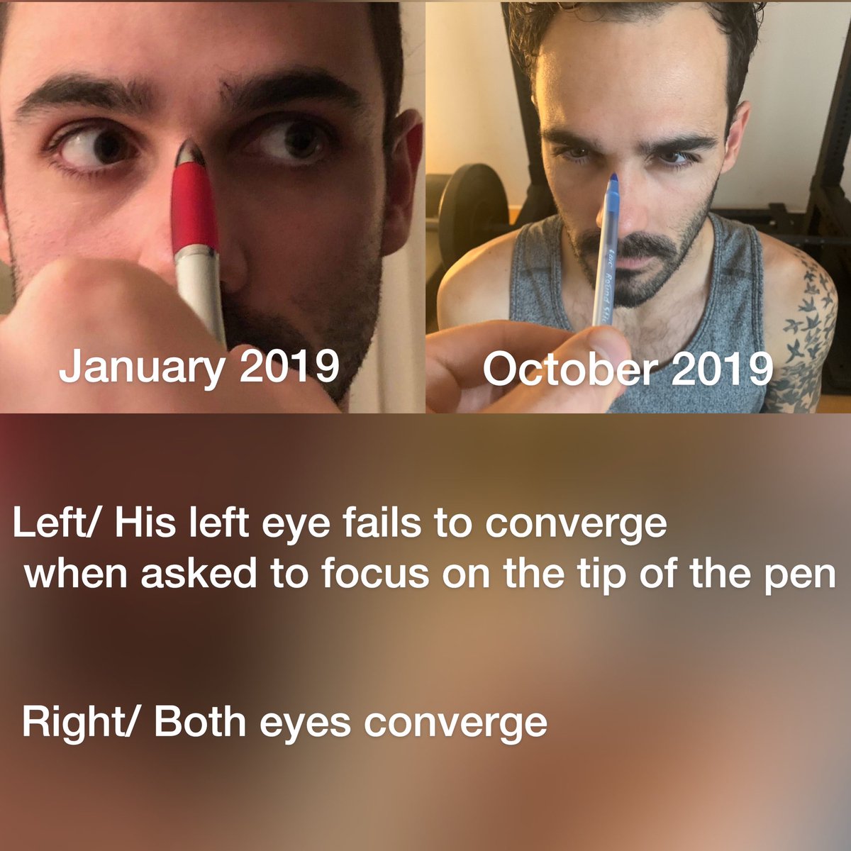 Here is another client with an eye convergence insufficiency. His left eye would rotate in the opposite direction when he focused on the tip of pen. This imbalance caused severe neck pain and proprioception issues that we fixed with regular eye exercises.