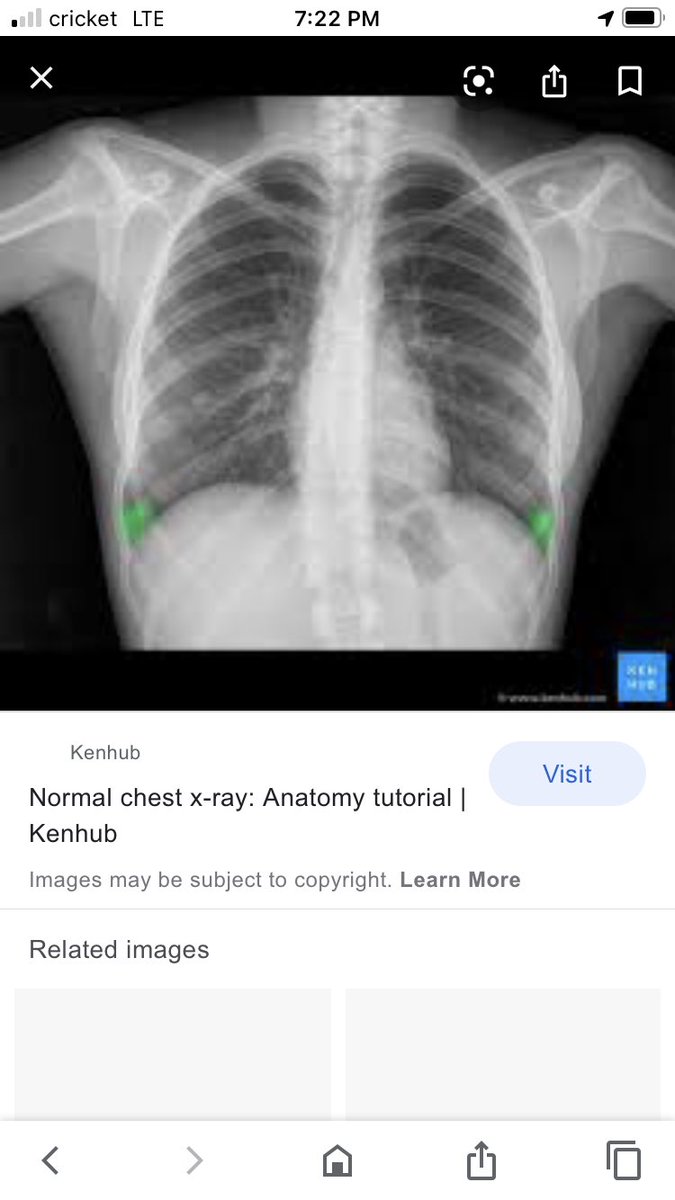 IcuGrad's tweet image. A normal chest X-ray vs a chest X-ray of someone with COVID-19. 

This is more than just the flu. Pray for us healthcare workers. We are tired and drained and not okay.