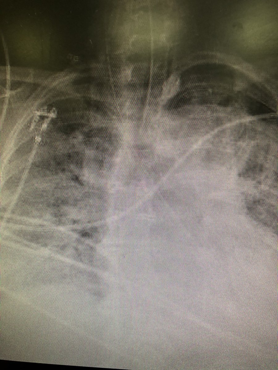 IcuGrad's tweet image. A normal chest X-ray vs a chest X-ray of someone with COVID-19. 

This is more than just the flu. Pray for us healthcare workers. We are tired and drained and not okay.