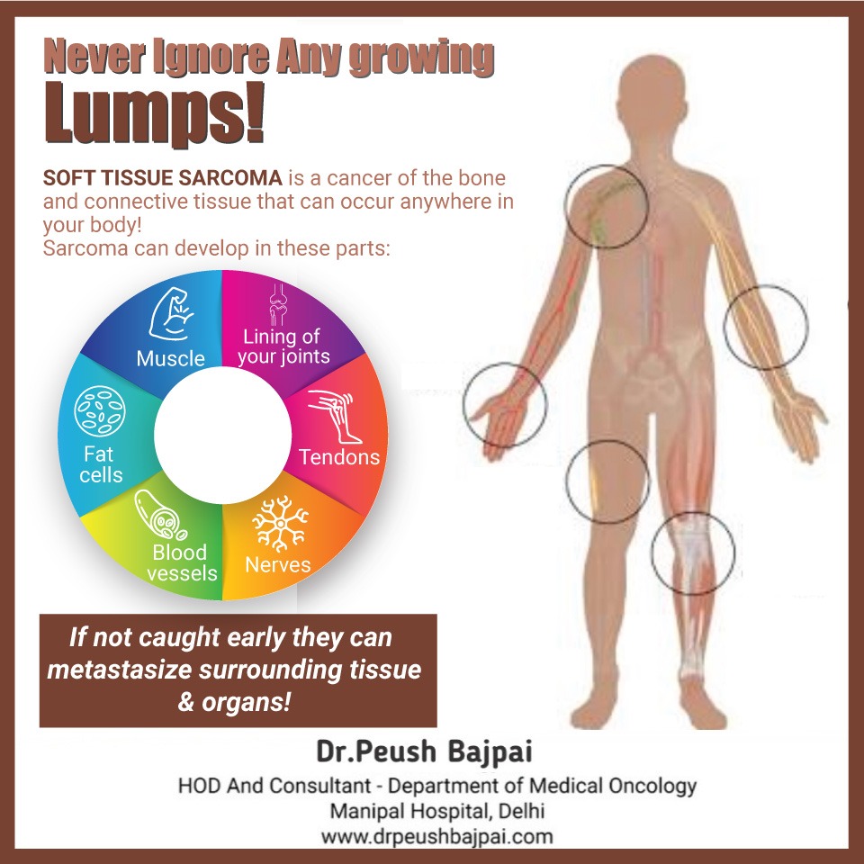 A soft tissue sarcoma is found mostly in the arms, legs, chest, and #abdomen.

These cancers may not cause any signs and symptoms in their early stages. 

#sarcoma #oncology #oncologist #Drpeushbajpai #Dwarka #Delhi #nerves #muscle #tendons #softtissue #signs