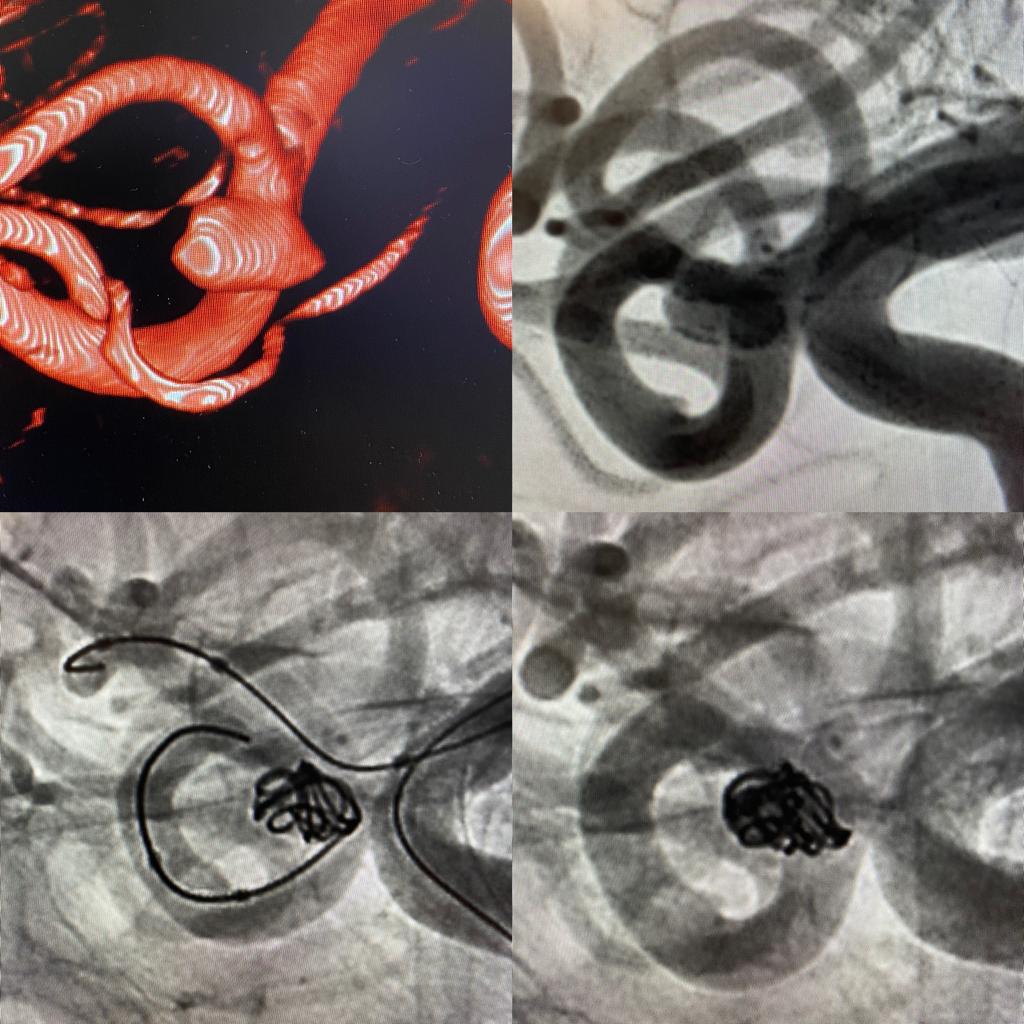 Seguimos fuertes en el tratamiento del cerebro. El equipo de Neuro-radiología intervencionista solucionando otro aneurisma en <a href="/HUInfantaElena/">Hosp. Infanta Elena</a>. Gracias.... <a href="/Dr_CRdguez/">Claudio Rodríguez Fernández</a> <a href="/G_Mon_Her/">Gonzalo Monedero Herrador</a> <a href="/AntonioCartu18/">Enfermeria Intervencionista Hospital Infanta Elena</a> <a href="/AnaArev97466261/">Ana Arevalo</a>.