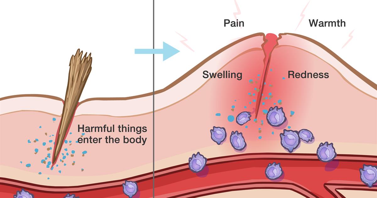Inflammation is the body's response to poison, toxins, or trauma.ACUTE Inflammation is good when you cut yourself or turn an ankle& plasma proteins, white blood cells, & plateletsTravel to the site of injuryto heal & prevent infection.2/6