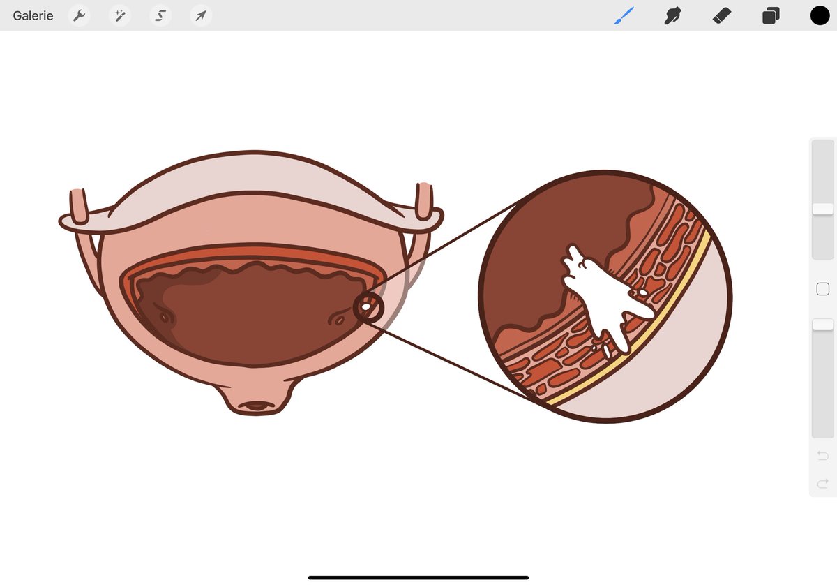 RomDiamand's tweet image. ✍️ How to explain #bladdercancer and #cystectomy to patients ? Ongoing project #sketch #Procreate @EauPatient @sb_uro @JulesBordet
