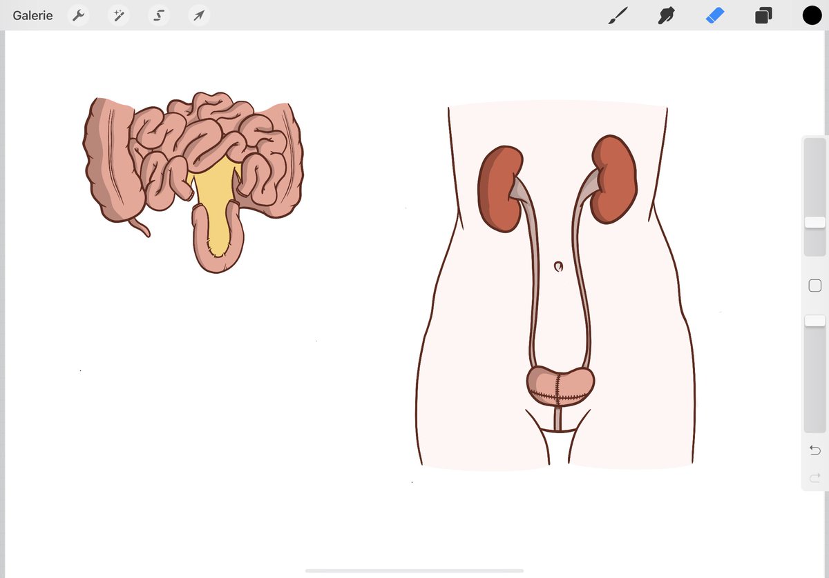 RomDiamand's tweet image. ✍️ How to explain #bladdercancer and #cystectomy to patients ? Ongoing project #sketch #Procreate @EauPatient @sb_uro @JulesBordet
