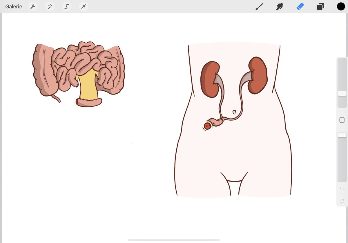 RomDiamand's tweet image. ✍️ How to explain #bladdercancer and #cystectomy to patients ? Ongoing project #sketch #Procreate @EauPatient @sb_uro @JulesBordet