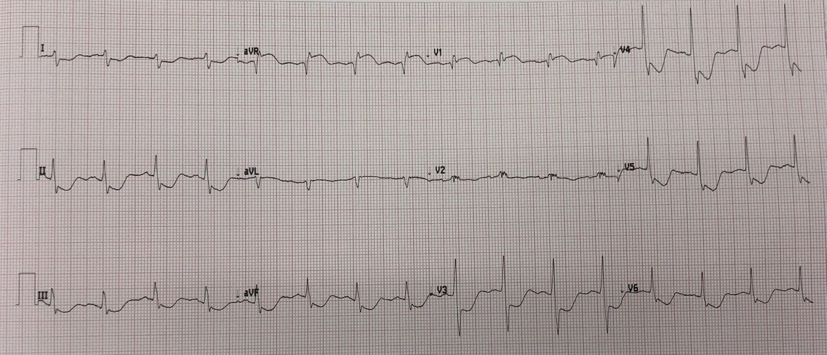 smithECGBlog's tweet photo. Extreme widespread ST depression, with ST Elevation in aVR. What do you think?

https://t.co/DWxRCyPoXg https://t.co/QPHqnWfwwt