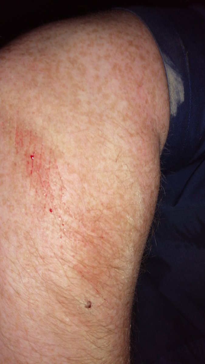 BigCodsy's tweet photo. Fucking face planted coming out of work, took a shortcut in the dark and didnt see a step, down like a sack a spuds in front of all the traffic on the glenshane road, hopefully it was too dark to see me properly #timberrrrr #redner https://t.co/vT6NI52TAv