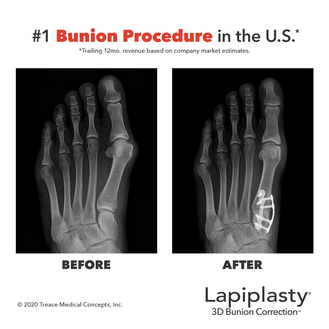 The Lapiplasty® Procedure quickly became the #1 Bunion Procedure in the U.S.* by addressing the root cause of bunions, delivering much more than a cosmetic fix.

*Trailing 12mo. revenue based on company market estimates

Learn the benefits and risks at AlignMyToe.com