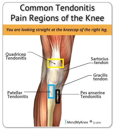 MendMeShop's tweet photo. Common regions of the knee that are affected by tendonitis. https://t.co/iHt0kVwHAi #mendmeshop #tendinitis #kneepain https://t.co/fkTYjKnzua