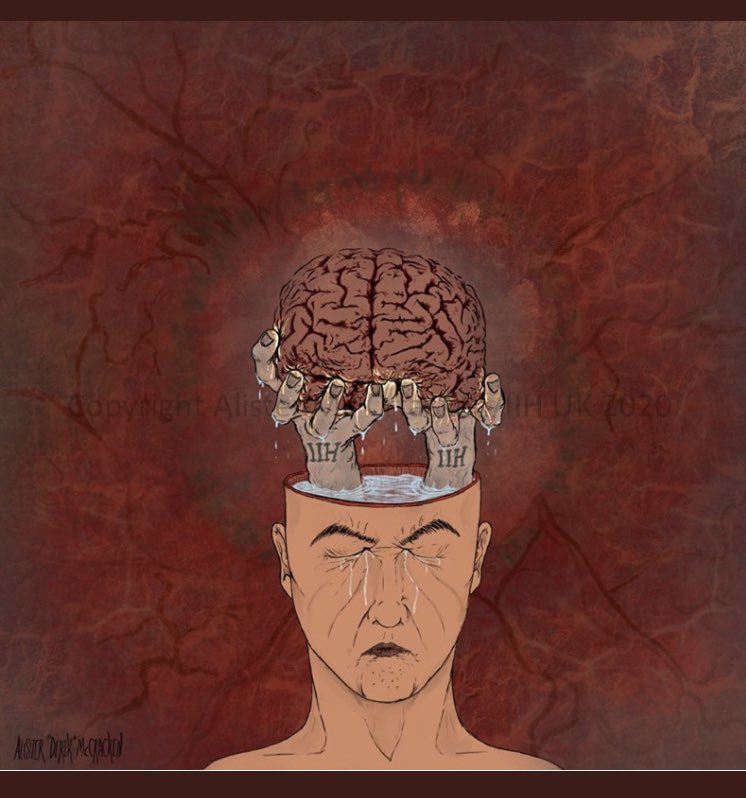 BrainLabBhamUk's tweet image. IIH ART competition 2020 winners were announced today Alister McCracken in the adult category created such poignant piece bringing together the papilloedema , brain pain and brain fluid.  Amazing powerful work @IIHUK @GalacticZoo @BHPComms @IMSR_UoB @UK_headache @DrMollan