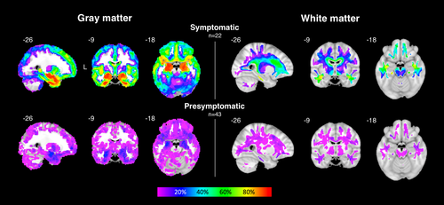 Brain volumetric deficits in MAPT mutation carriers: a multisite study. A subset of presymptomatic carriers showed low volumes in mesial temporal lobe, the region atrophied in all symptomatic carriers. bit.ly/34f9rnf @allftd @lee_suzee @SalvoSpinaSF @YokoyamaLabUCSF