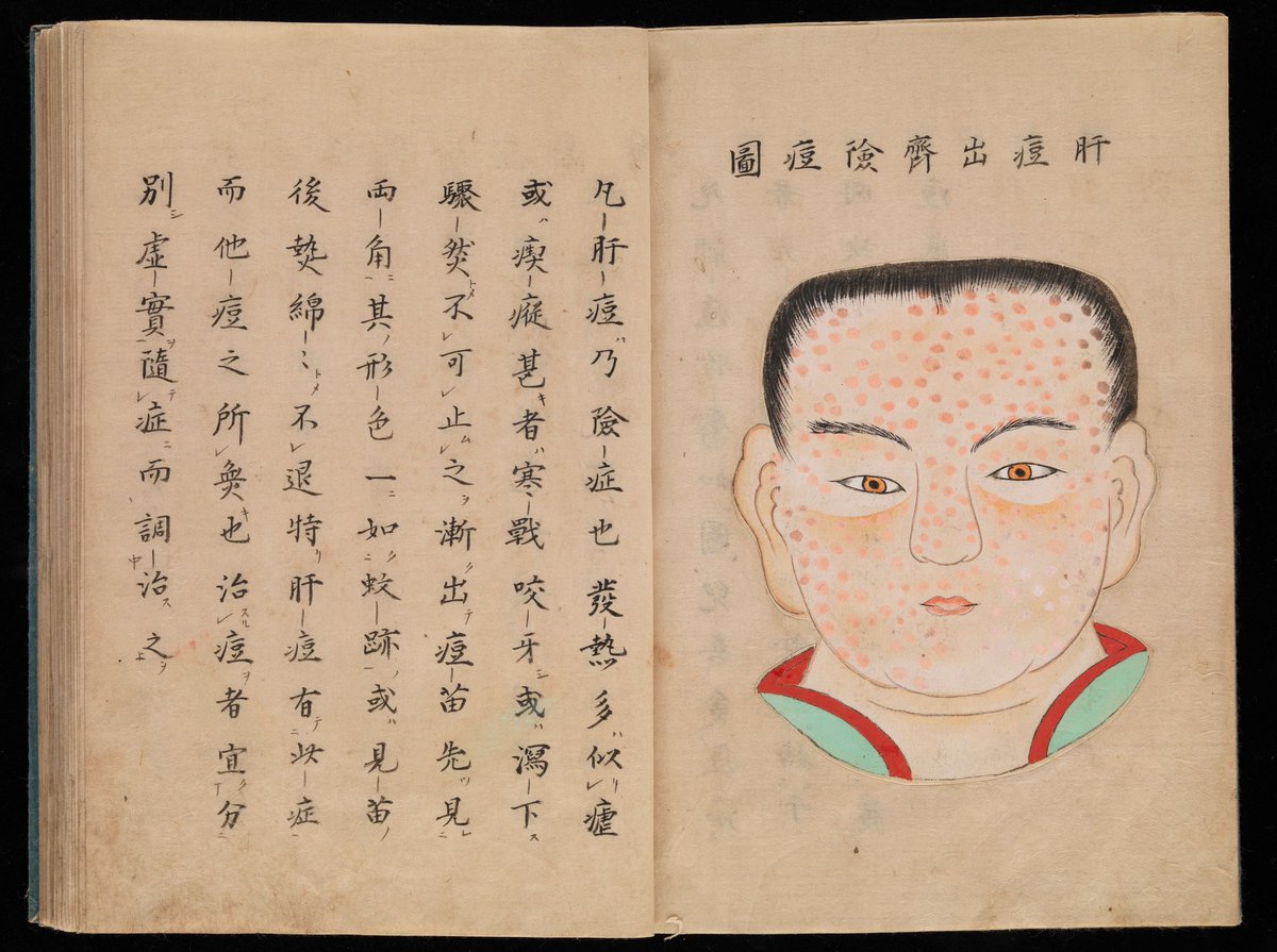 Variolation is specific to smallpox (Latin: variola, hence the name), and it involves introducing fluid from the pustules of a person afflicted with smallpox into the body of a healthy individual. In China, scab material was ground up and snorted. (7/24)