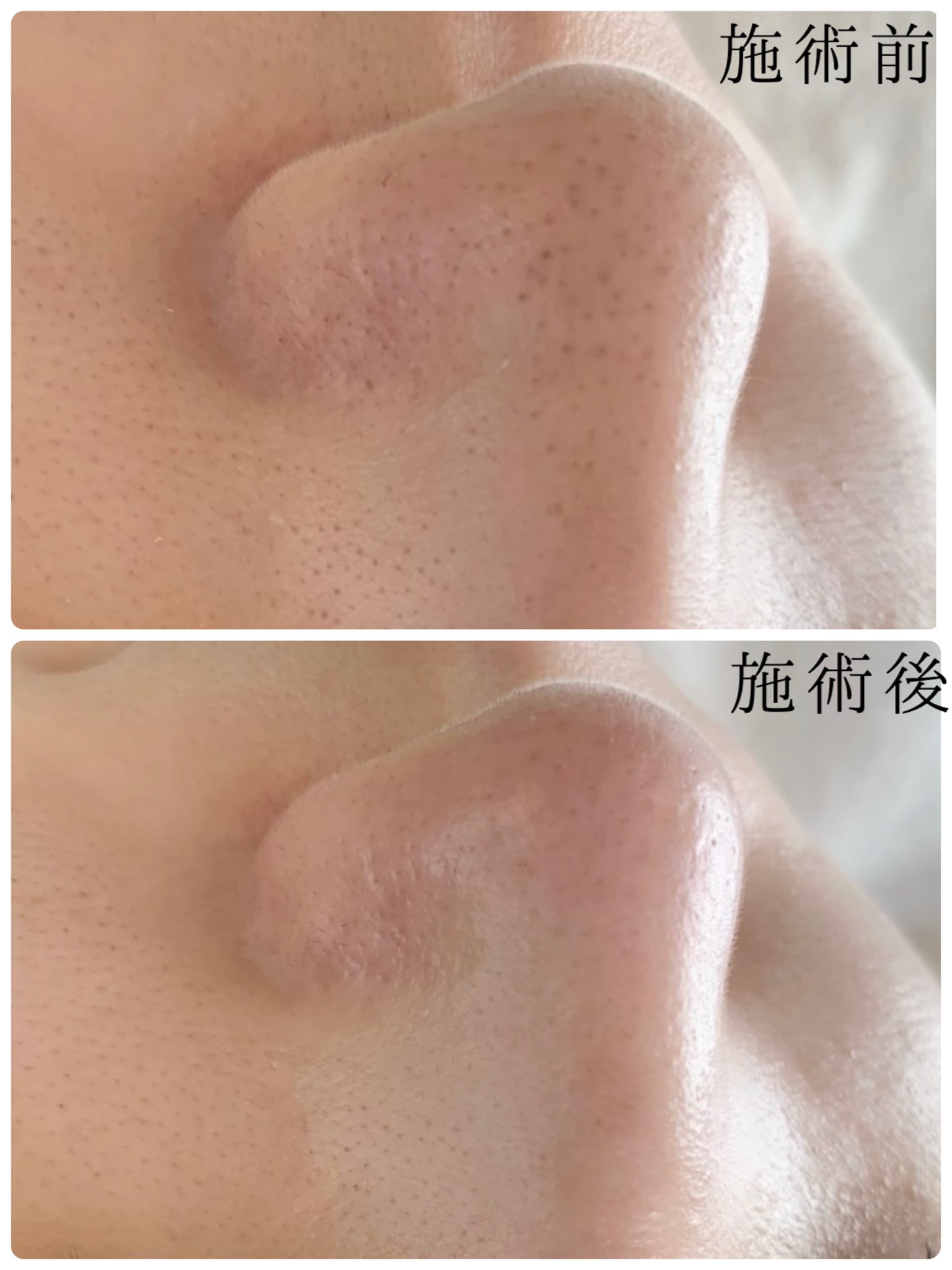 毛穴研究所 毛穴研究所では皮脂分泌量が多い角栓詰まり 炎症刺激による角栓詰まりなどその原因に合わせたアドバイス 施術を行なっております T Co Tociqy7gbl 毛穴研究所 光フェイシャル 毛穴洗浄 T Co Ca1huvplap Twitter
