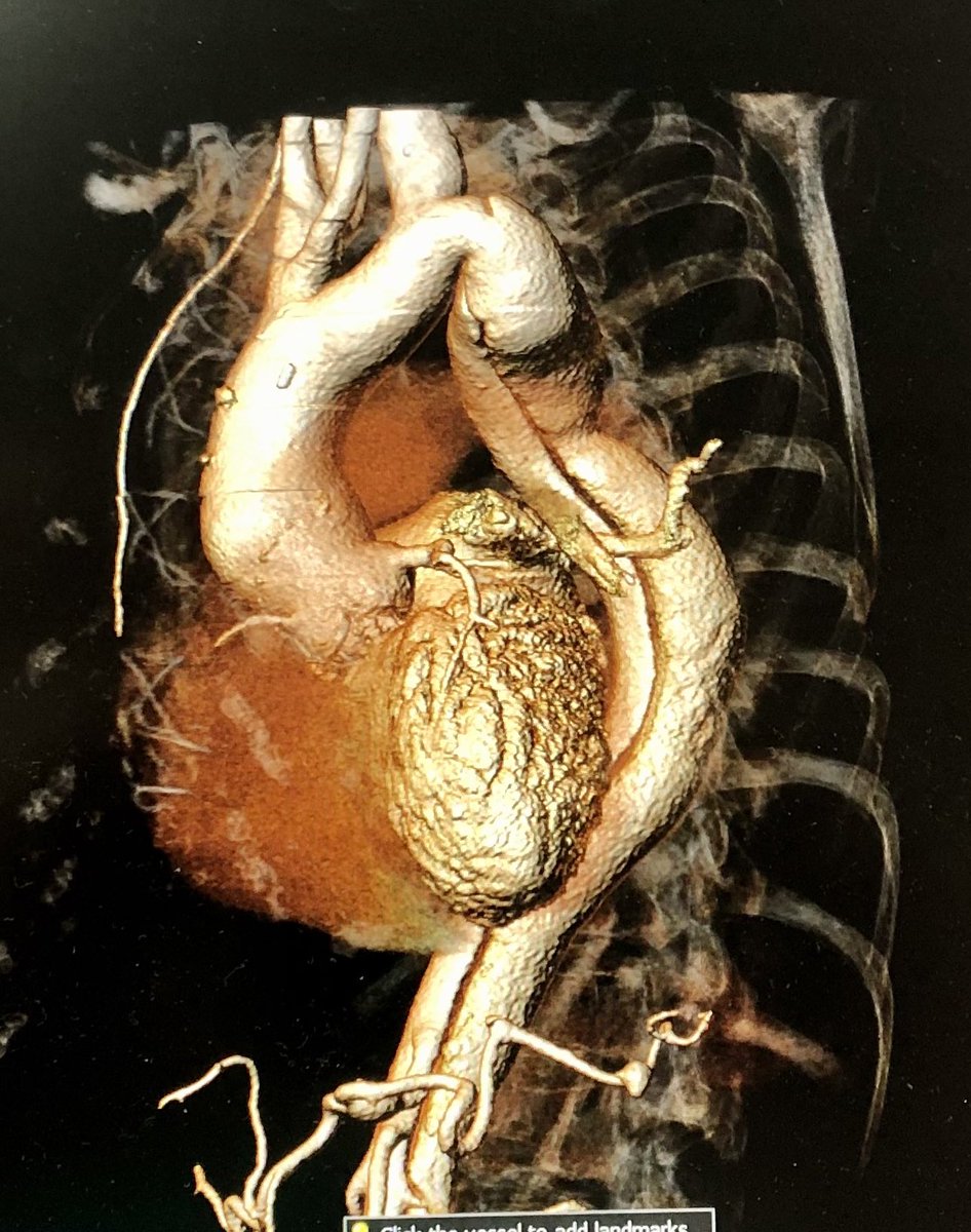 69yo, class 4 HF under amines, LVEF of 15-20%, gradient of 86/55mmHg and AR 3/4; previous biological prosthesis (CE 21mm in 2006 for severe bicuspid disease). Important comorbidities: psoriatic arthritis (under metrotrexate and methylprednisolone) and type B Aortic dissection...