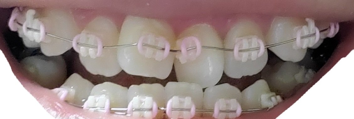 あんず 受け口矯正中 Ukeguchichan Twitter