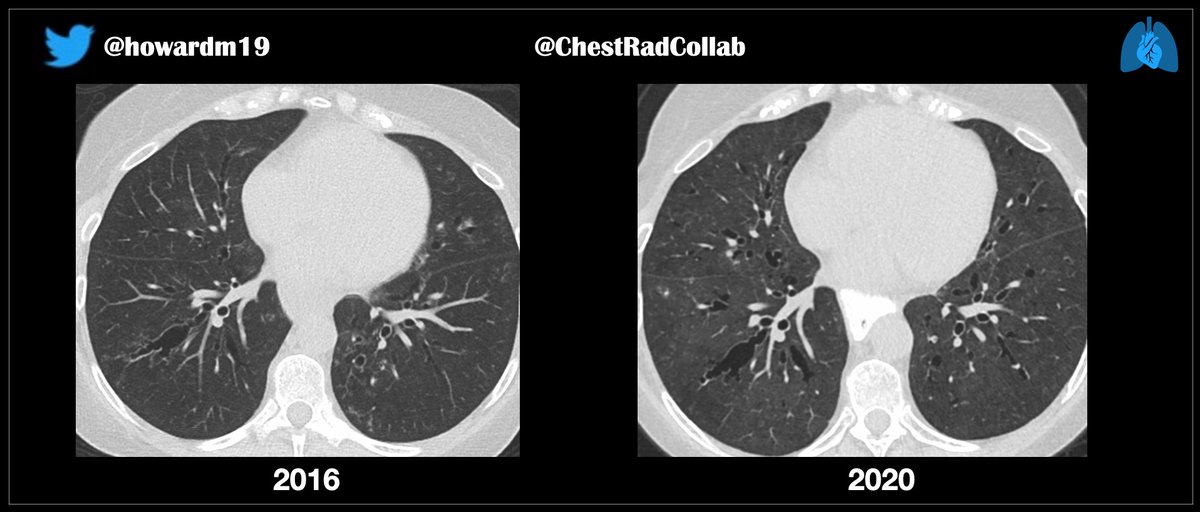 chestradcollab's tweet photo. @JeffreyKanneMD @TanMohammedMD @LucyModahlMD @smlungpathguy @LungPathGuys 

Case for STR Webinar tomorrow. (3 images)

Patient with Sjogren syndrome &amp; limited cutaneous scleroderma.  

• what are the findings ?
• by what pathomechanisms are they formed ?

#pulmpath  #ChestRadED https://t.co/Dk7Ha0RXaJ