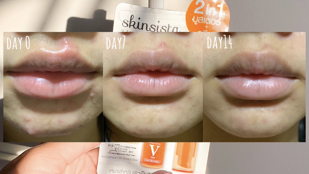 nutnut_b's tweet photo. @SkinsistaTH 🧡ครีมซองลดสิวที่ทุกควรลอง ช่วงนี้คือสิวบุกหนักมาก ไปเจอซองสีส้มในเซเว่น สูตรลดสิว เห็นใครๆก็ใช้ เลยจัดมาบ้าง ทาซองเดียวจบ 2in1บูส��ตอร์และครีม สิวยุบแห้งไว รอยแดงจางลงด้วย ตามไปใช้ได้ดีจริง ยกให้เป็นลูกรักเลย #ใช้ดีบอกต่อ #ครีมซองเซเว่น https://t.co/6WEjwpxIuk