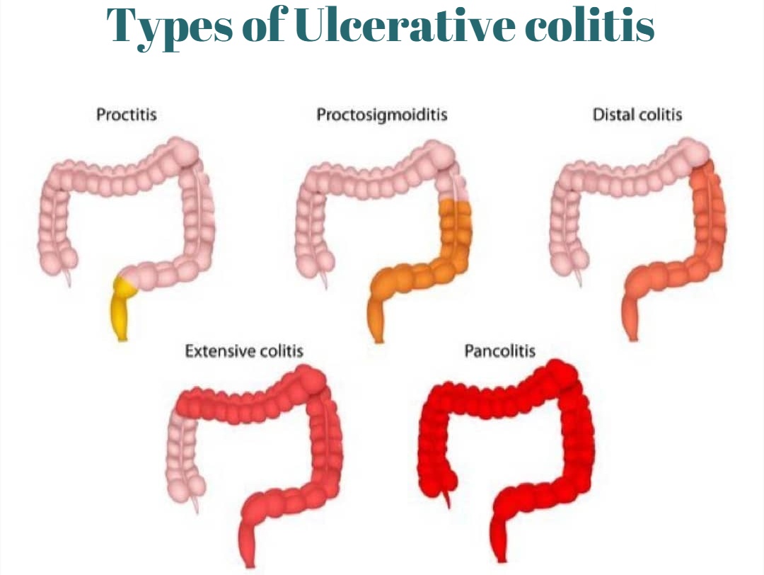 The efficiency of #UlcerativeColitis treatment by fetal #stemcells is caused by their ability
1) to replace the damaged intestinal cells with healthy ones;
2) to eliminate the aggression of the immune system to own tissues and block the autoimmune reaction
uctclinic.com/ulcerative-col…