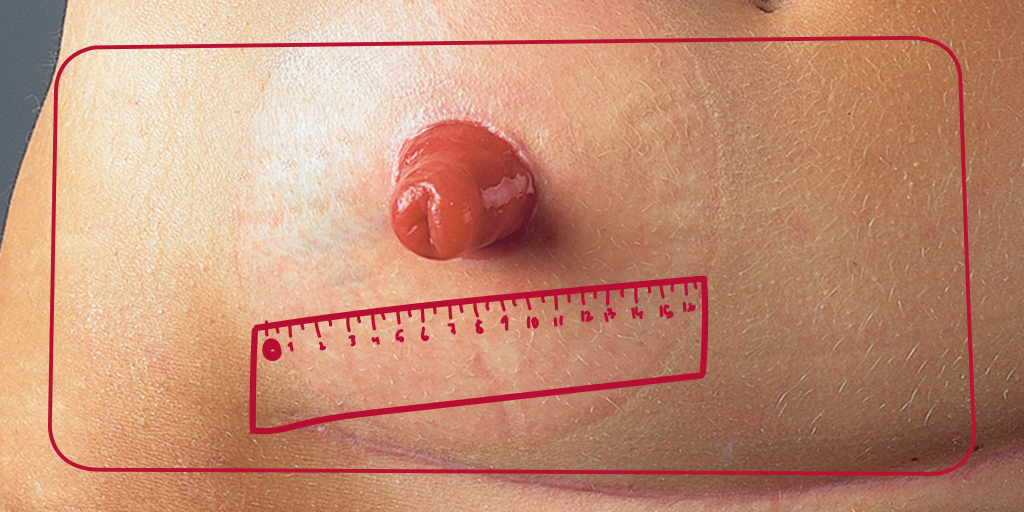 proyectoGESTO's tweet photo. 🔴El tamaño del #estoma cambia a lo largo de la vida de un paciente #ostomizado, especialmente durante las primeras semanas tras la cirugía.
📏 Mide tu estoma frecuentemente para ajustar la lámina de #ostomía y mantener la piel periestomal cuidada y sana.
#TipsGESTO #skinhealth https://t.co/lCVBxtPKqu