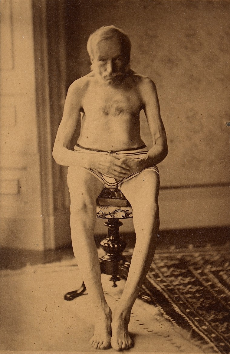 Others have theorised that his deafness was caused by Paget’s disease of bone, although this is uncommon in people Beethoven’s age (he died aged 56). This can affect the skull, with the nerve and bone damage causing deafness.