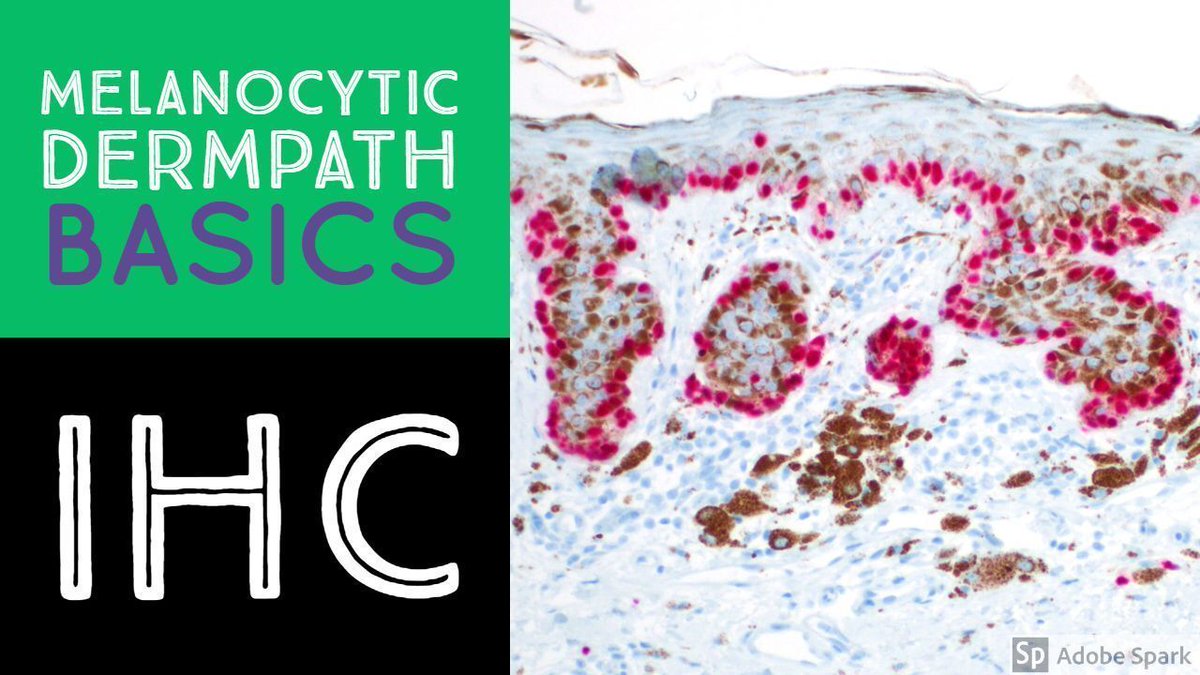 JMGardnerMD's tweet image. Most melanocytic skin lesions can be diagnosed by H&amp;amp;E, but in some cases, immunostains can be very useful. This video shows my basic approach to using #IHCpath to help distinguish nevus from #melanoma. buff.ly/2NzAoLf #dermpath #Pathology #dermatology