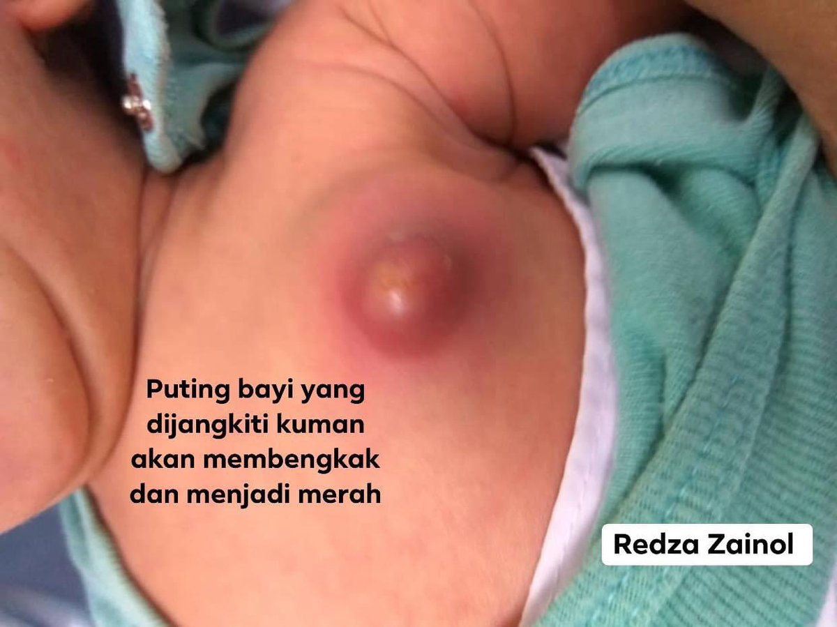 DrRedzaZainol's tweet photo. “Kenapa jadi sampai macam ni?”

Dari tadi bayi ni nangis tak henti-henti. Minum susu badan sekejap kejap, kemudian menangis semula. https://t.co/kMiS3fck72