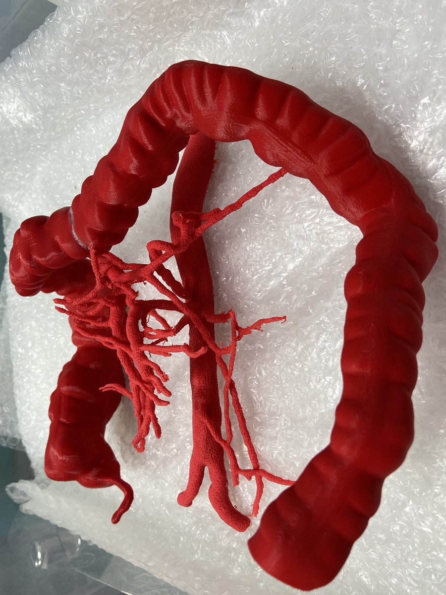 MaterSurgery (@matersurgery) on Twitter photo Fantastic to have <a href="/UCDMedicine/">UCD Medicine</a> Anatomy’s Christian Myles’s beautiful 3d printed physical models alongside the <a href="/VisiblePatient/">VisiblePatient</a> digital personalised anatomical maps ahead of radical colon cancer surgery, CME & CVL. With great thanks to <a href="/Jordanfletch6/">Jordan fletcher</a> #digitalsurgery #bettersurgery Fantastic to have <a href="/UCDMedicine/">UCD Medicine</a> Anatomy’s Christian Myles’s beautiful 3d printed physical models alongside the <a href="/VisiblePatient/">VisiblePatient</a> digital personalised anatomical maps ahead of radical colon cancer surgery, CME & CVL. With great thanks to <a href="/Jordanfletch6/">Jordan fletcher</a> #digitalsurgery #bettersurgery