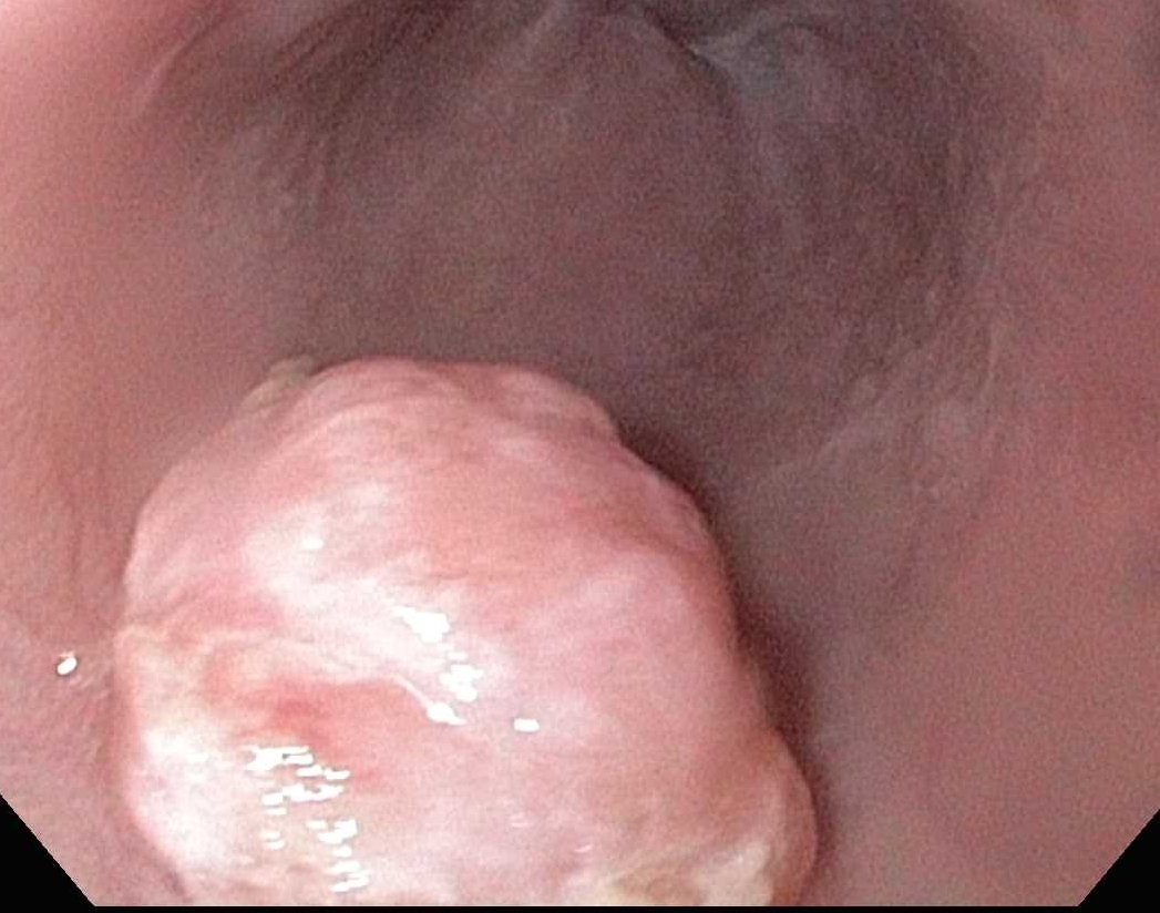 ginorthshore's tweet photo. Here's a polyp of a different flavor. What say you on histology #GITwitter? Is this @BrennanSpiegel's (in)famous fibrovascular polyp? AdenoCa? GIST? Met? Squamous CA? Squamous papilloma? Other? #PolypThursday @stevenbollipo @GI_Pearls @AllonKahn @DrHarryThomas @BilalMohammadMD https://t.co/fOmjSfLGly