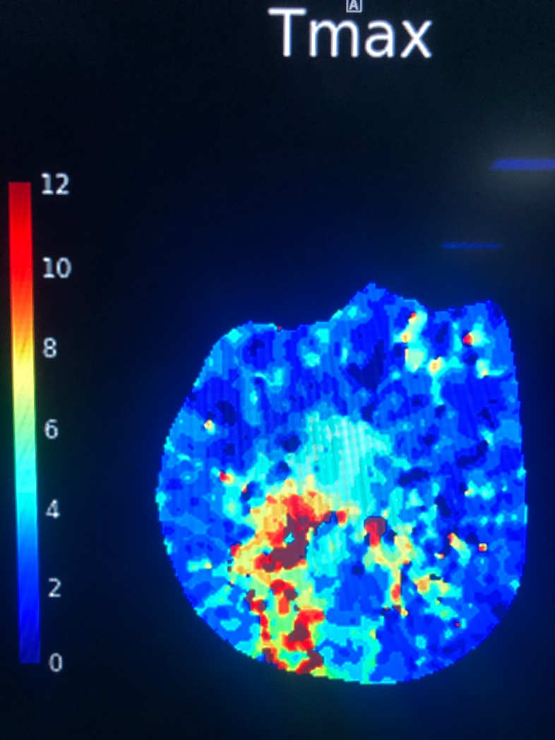 Dr__Makki's tweet photo. Am glad to present stroke NeuroImaging focusing on CTP in my birthday, my gift to health providers involved in stroke Pt management.
Everyone is welcome to join the Saudi Stroke Society meeting organized by event troop, free registration with CME. 
@EventTroop 
@saudistroke911 https://t.co/4s4UMVJobQ